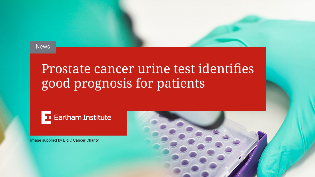 Prostate Cancer Urine Test Identifies Good Prognosis For Patients 4950